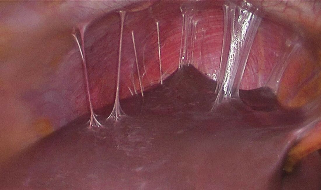 Uludağ Üniversitesi’nden fıtık oluşumunu engelleyecek proje Bursa Uludağ Üniversitesi (BUÜ) Mühendislik Fakültesi Tekstil Mühendisliği Bölümü Öğretim