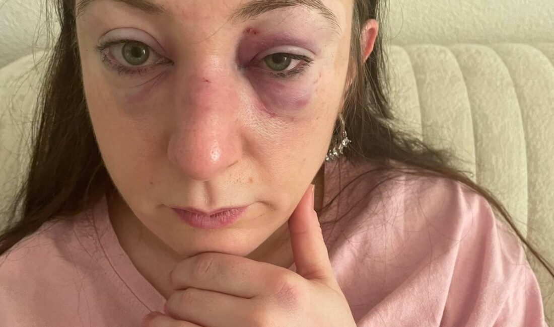 Bursa'da bir kadın eski erkek arkadaşı tarafından öldüresiye darbedildi.