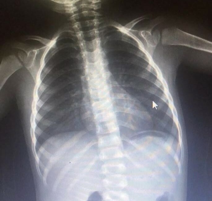 Bursa’da çivi yutan çocuk hastaneye kaldırıldı Bursa’nın İnegöl ilçesinde çivi yutan 2 yaşındaki çocuk hastanelik oldu.