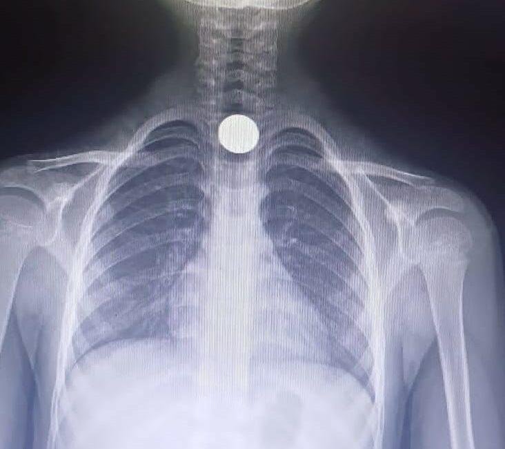 Bursa’nın İnegöl ilçesinde, yolda bulduğu parayı yutan çocuk hastanelik oldu.