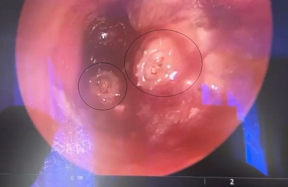 Bursa’da çocuğun kulağından 2 kurtçuk çıkarıldı BURSA YÜKSEK İHTİSAS EĞİTİM VE ARAŞTIRMA HASTANESİ’NDE 13 YAŞINDAKİ ERKEK