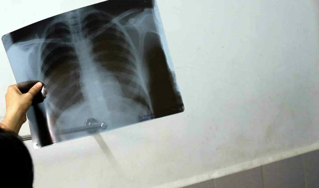 Bel ağrılarınız iltihaplı romatizma olabilir Bel ağrısı özellikle masa başı çalışanlar ve uzun süre ayakta