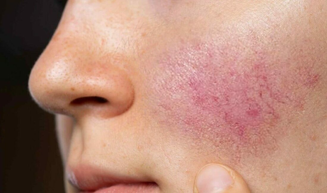 Hayat Hastanesi Dermatoloji Uzmanı Dr. Mediha Yılmaz, halk arasında ’gül