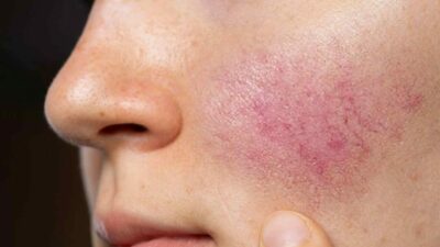 Hayat Hastanesi Dermatoloji Uzmanı Dr. Mediha Yılmaz, halk arasında ’gül