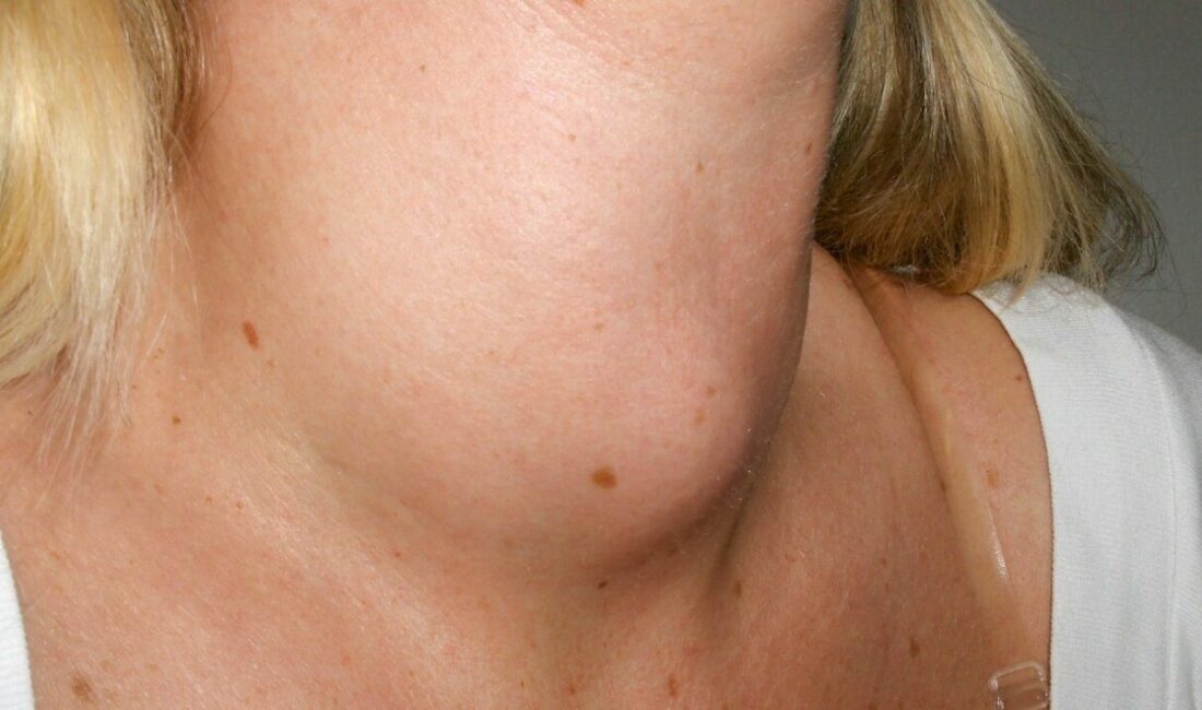 Boynunuzda şişlik varsa dikkat Toplumda yaygın olarak görülen endokrin hastalıklardan biri olan guatr, tiroid