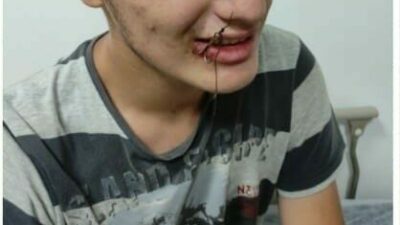 Bursa’nın Yenişehir ilçesinde ağzına balık oltası iğnesi takılan çocuk, itfaiye