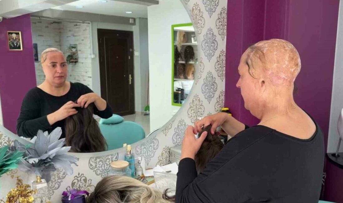 12 yaşında saçlarını ve kulaklarını kaybetti, şimdi kadınlara umut oluyor Küçük yaşta geçirdiği feci iş kazasında saçlarını ve kulaklarını kaybeden